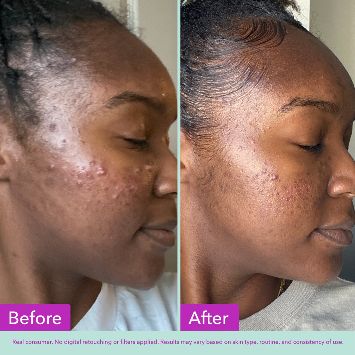 acne-foaming-cleanser-b1 zb_p.jpg